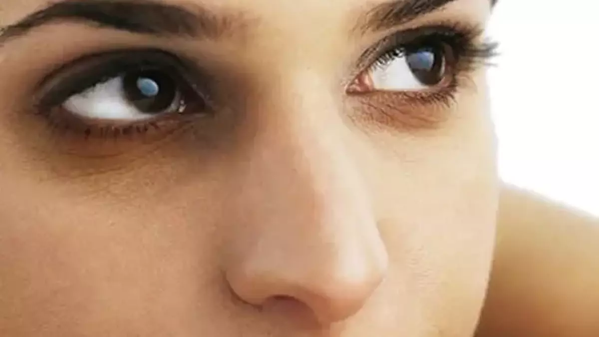 Почему синяки под глазами — это не просто косметическая проблема?