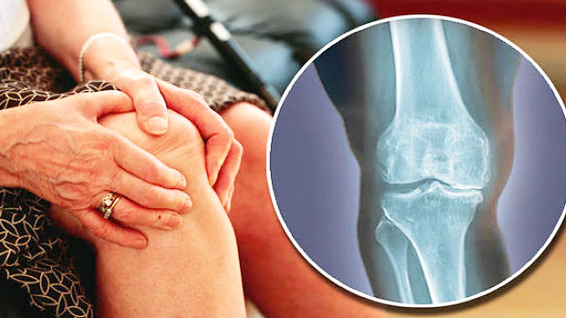 Как лечат артроз в 2025 году